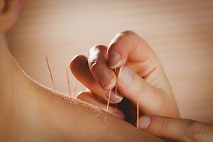 Acupuncture. acu 1